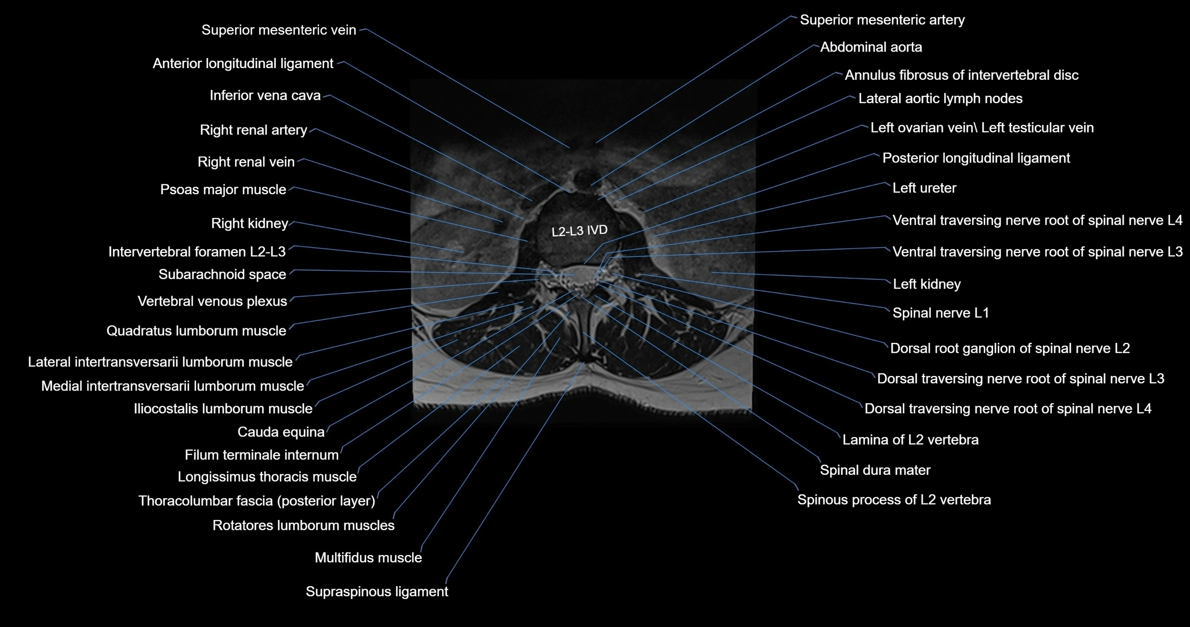 MRI lumbar spine axial cross sectional anatomy 3T radiology  image-img-00001-00017.webp